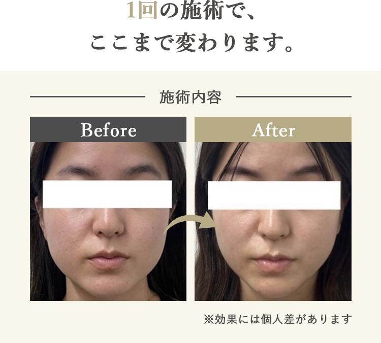1回の施術で、ここまで変わります。